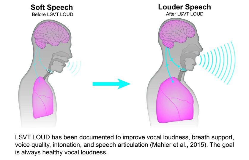 LSVT Loud Therapy